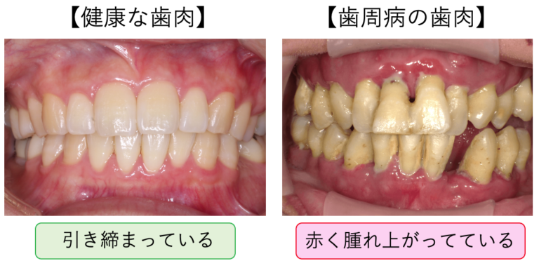健康な歯肉と歯周病の歯肉の比較写真