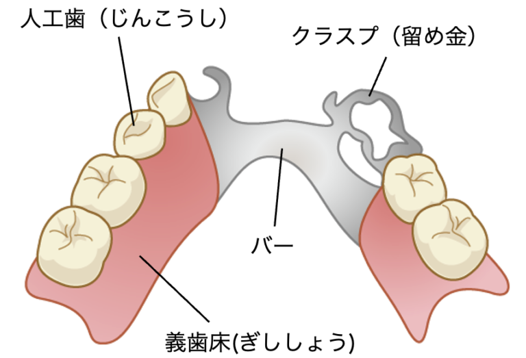 部分床義歯（部分入れ歯）