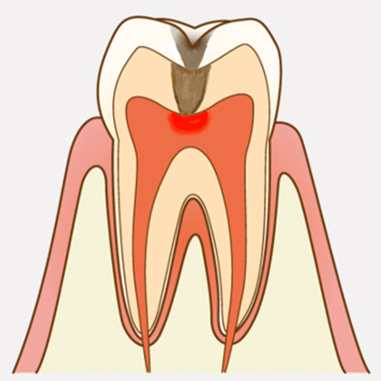 歯髄（歯の神経）まで進行したカリエス