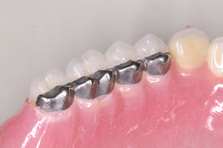金属歯義歯