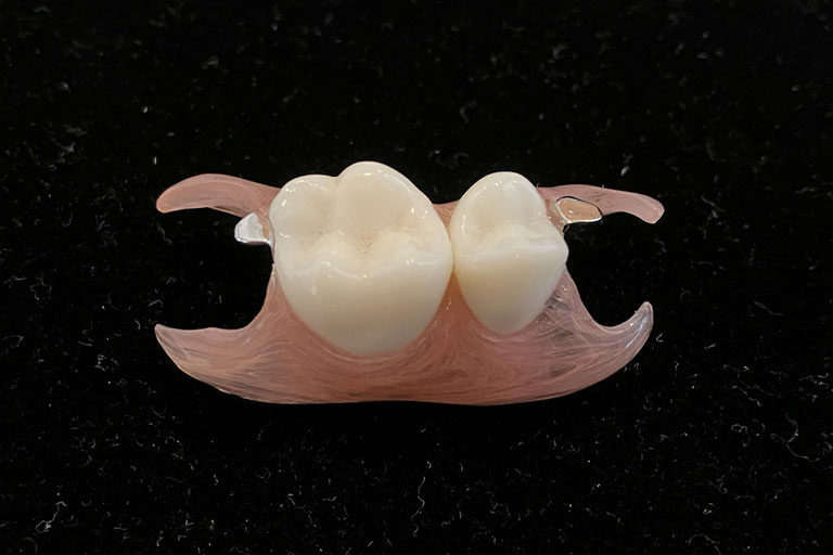 ノンメタルクラスプ義歯