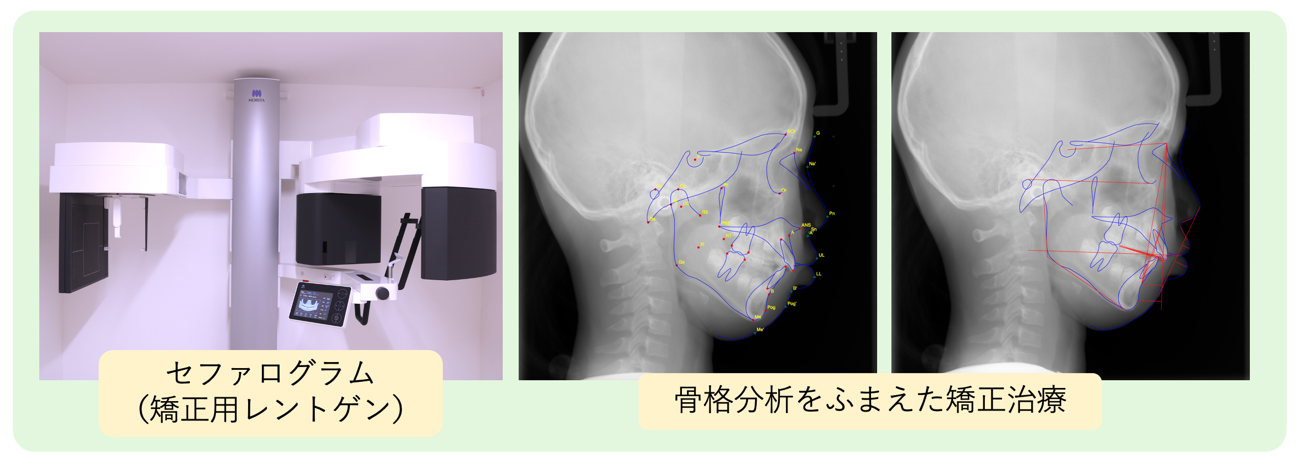 セファログラム（矯正用レントゲン） 骨格分析を踏まえた矯正治療