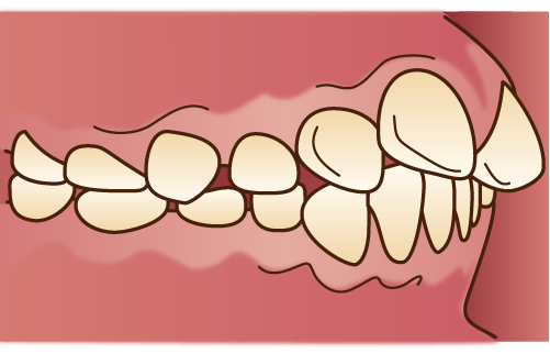 上顎前突