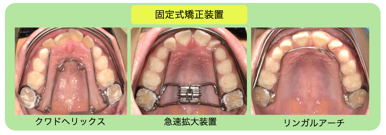 固定式矯正装置